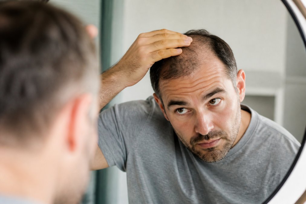 Hair Loss: Causes, Treatments & Natural Care
